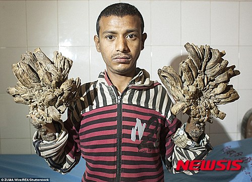 【서울=뉴시스】방글라데시에 사는 아불 바잔다르(25)라는 이름의 남성이 마치 나뭇가지처럼 보이는 양 손을 들고 있다. 이 남성의 손가락은 약 7년 전부터 마치 나뭇가지처럼 변하기 시작했다. 바잔다르의 손이 이렇게 변해버린 것은 우취성 표피이상, 혹은 사마귀상 표피이상이라고 불리는 바이러스감염증으로 여겨지는 질환 때문이다. 이 질환의 발병 원인은 주로 유전적 원인이나 세포성 면역 저하 등으로 추정되고 있다. (사진출처: 데일리메일) 2016.01.31.&nbsp; 