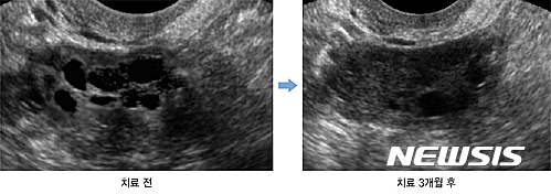 【서울=뉴시스】다낭성난소증후군 치료 전·후 초음파 사진