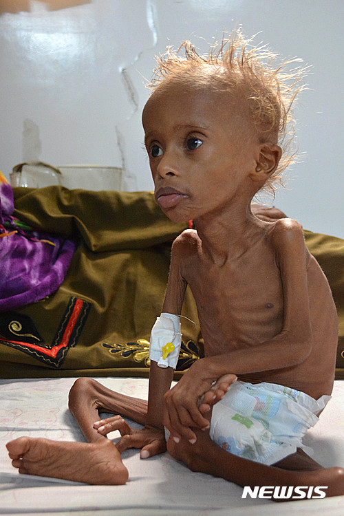 【후데이다=AP/뉴시스】예멘 수도 사나 인근 후데이다의 한 병원에서 지난 9일(현지시간) 뼈만 앙상하게 남은 5살난 어린이가 치료를 받고 있다. 장기간 내란 중인 예멘에서는 5살 이하 어린이의 31%가 기아에 시달리고 있다. 2016.10.28 