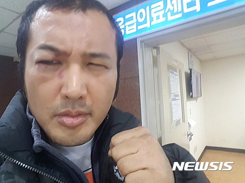 【서울=뉴시스】소아암 어린이를 돕기 위해 종합격투기 '로드 FC' 데뷔전을 치른 배우 김보성이 안와골절 부상을 입었다.(사진=로드) 