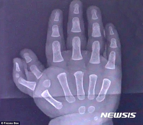 【서울=뉴시스】엄지손가락이 2개인 카터의 오른손 엑스레이(X-Ray) 사진. (사진출처: 데일리메일) 2017.03.10.