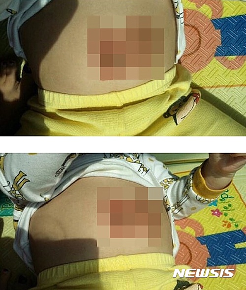 【서울=뉴시스】안아키 카페 민간요법 실천한 모습(사진출처= 인터넷 커뮤니티 게시판)