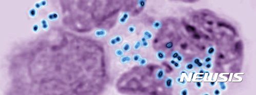 【서울=뉴시스】 구강성교(Oral sex)가 난치성 ‘슈퍼 임질 박테리아’를 유발시킨다는 연구결과가 나왔다. 또한 콘돔 사용의 감소로 인해 고위험성 임질이 확산되고 있는 것으로 나타났다.BBC방송의 7일(현지시간) 보도에 따르면 세계보건기구(WHO)는 77개국을 대상으로 조사를 한 결과 항생제에도 듣지 않는 임질이 확산되고 있는 것으로 나타났다. 이번 조사 결과 매년 7800만 명 이상이 성 관련 질환(STI)에 걸리고 있는 것으로 밝혀졌다. <출처: BBC방송> 2017.07.07.