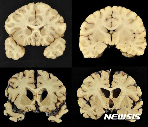 【AP/뉴시스】스마트폰, 태블릿PC, 비디오 게임 등에 하루 7시간 이상 노출된 아동들의 대뇌피질이 정상보다 빨리 얇아진다는 연구 결과가 9일(현지시간) 미 언론 CBS를 통해 보도됐다. 사진은 보스턴대가 공개한 풋볼 선수와 일반인의 두뇌 비교 사진으로, 이 기사와 직접적 관련 없음. 2018.12.10.