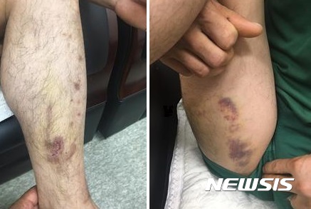 【수원=뉴시스】김도란 기자 = 지난 6월 불법체류자 단속과정에서 수원출입국관리사무소 직원들에게 폭행을 당했다고 주장한 외국인근로자 A(35·중국 국적)씨가 부상당한 신체부위를 보이고 있다. 2017.8.29 photo@newsis.com