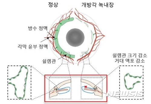 【대전=뉴시스】 녹내장은 안압을 유지하고 안구를 형성하는 방수를 배출하는 통로에 문제가 생겨 발생한다. 방수의 이동통로이 쉴렘관이 망가지면(사진 오른쪽) 안압이 상승하게 된다. 하지만 그동안 원인을 분자적인 수준에서 밝히지 못해 근본적인 치료도 기대하기 어려웠다.