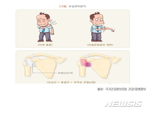 [알아봅시다]오십견, 더 이상 50대 女 전유물 아냐