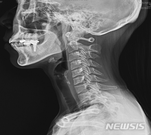 【서울=뉴시스】일자목.2018.02.25(제공=국민건강보험 일산병원) 