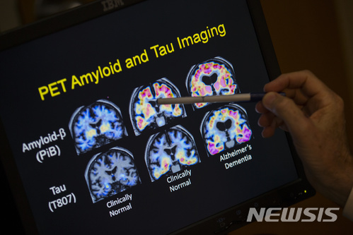【워싱턴=AP/뉴시스】2015년 5월19일 미 워싱턴 조지타운 대학병원 뇌이상센터에서 스콧 터너 소장이 PET 뇌 스캔 사진을 보고 있다. 과학자들은 기억력 상실이나 다른 치매 증상에 따라 알츠하이머병을 진단하던 기존의 방법 대신 뇌의 변화와 같은 생물학적 신호에 따라 알츠하이머병을 진단하는 새로운 방법을 택해야 한다고 제안하고 있다. 2018.4.10