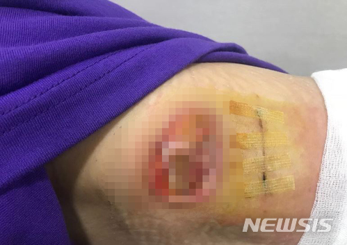 【서울=뉴시스】23일 한예슬이 인스타그램에 공개한 상처 모습. 