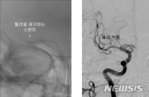 【부산=뉴시스】 제갈수만 기자 = 인제대학교 해운대백병원 신경외과 진성철 교수팀은 뇌경색 환자를 대상으로 막힌 뇌혈관을 뚫어 최악의 상황을 막아주는 '하이브리드 혈전 제거술'로 기존의 치료법보다 나은 결과를 나타내고 있다고 12일 밝혔다. 사진은 시술전과 후의 혈관 모습이다. 2018.06.12. (사진= 해운대백병원 제공)    photo@newsis.com