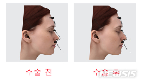 【울산=뉴시스】박일호 기자 = 울산대학교는 교원창업기업 (주)넥스트코어가 울산의대 이태훈 교수 등과 함께 수술 보조기구인 '환자맞춤형 코 성형 수술 가이드' 제품을 개발했다고 25일 밝혔다. 사진은 가이드 제품 설명. 2018.06.25. (사진=울산대학교 제공) photo@newsis.com