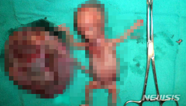 【서울=뉴시스】이예슬 기자 =&nbsp; 17일 워마드 게시판에서는 낙태한 태아가 훼손된 사진을 쉽게 찾아볼 수 있었다. 초록색 수술복 위에 낙태된 태아가 수술 가위 옆에 누워 있는 사진이다.&nbsp; 다만 해당 사진은 구글 이미지에서 차용한 것으로, 실제로 글쓴이가 낙태를 한 뒤 그 태아의 모습을 찍은 것은 아닌 것으로 보인다. (사진=워마드 갈무리) ashley85@newsis.com