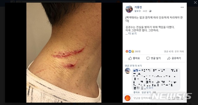 【서울=뉴시스】기동민 더불어민주당 의원이 자신의 페이스북에 올린 김경수 경남지사의 상처 사진. (사진 = 기동민 의원 페이스북 캡쳐) 2018.08.10.&nbsp; photo@newsis.com 