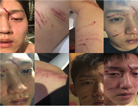 최종범씨. 구하라에게 폭행을 당해 입은 상처라면서 얼굴을 공개했다.