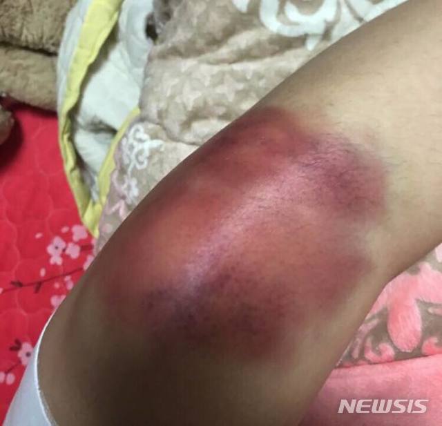 【서울=뉴시스】훈련 중 부상을 입었지만 보호대를 차지 못해 무릎 부상이 더 악화된 아사달 수습단원 모습. 2018.11.5(사진=홍익대학교 '대신 전해드립니다' 페이스북)&nbsp; photo@newsis.com