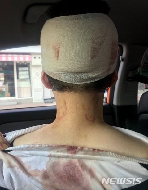 【서울=뉴시스】서울 동작구 이수역 인근 주점에서 지난 13일 발생한 폭행 사건의 피해자라고 주장한 여성이 온라인 게시판에 올린 부상 사진. 2018.11.15