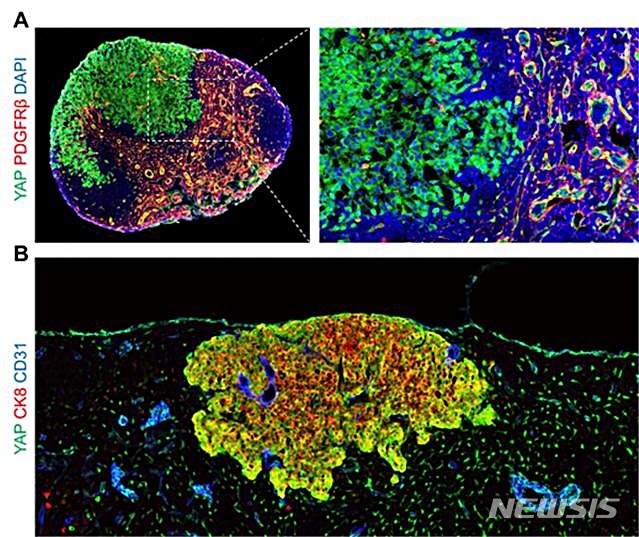 【대전=뉴시스】김양수 기자 = 암세포의 림프절 전이 과정에서 YAP의 역할. ISB 연구팀은 림프절에 전이된 흑생종(A)과 유방암(B) 모델 생쥐의 암세포를 형광염색법을 이용해 현미경으로 관찰한 결과 양쪽 모두에서 YAP 전사인자(진한 녹색)가 활성화된다는 것을 확인했다.2019.02.08(사진=IBS 제공) photo@newsis.com
