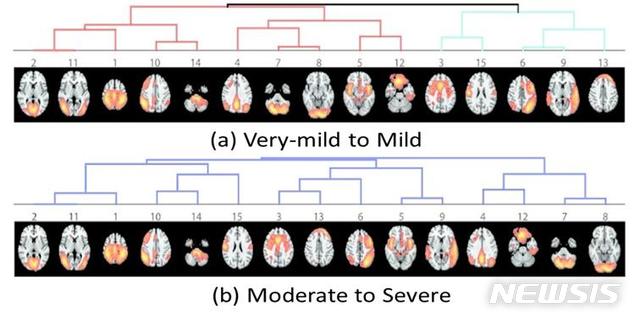 【광주=뉴시스】송창헌 기자 = 조선대 치매국책연구단이 광주과학기술원 연구진과 함께 MRI 뇌영상을 자동으로 분석해 알츠하이머병 진행 여부와 치매 진행단계를 판별해주는 인공지능기술을 자체 개발했다고 13일 밝혔다. 사진은 휴면상태 뇌내 네트워크의 치매 중증도별 특징. 2019.03.13 (사진=조선대 치매국책연구단 제공)photo@newsis.com