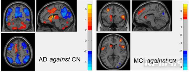 【광주=뉴시스】송창헌 기자 = 조선대 치매국책연구단이 광주과학기술원 연구진과 함께 MRI 뇌영상을 자동으로 분석해 알츠하이머병 진행 여부와 치매 진행단계를 판별해주는 인공지능기술을 자체 개발했다고 13일 밝혔다. 사진은 정상인 대비 치매환자군 및 정상인 대비 경도인지장애군의 뇌내 네트워크 활동성 비교. 2019.03.13 (사진=조선대 치매국책연구단 제공) photo@newsis.com