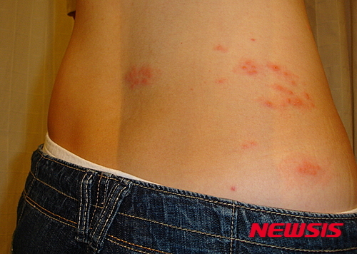 [서울=뉴시스] '띠 모양의 발진'을 뜻하는 병명에서 알 수 있듯 몸 한쪽에 띠처럼 수포가 올라오며 칼로 베는 듯한, 불에 타는 듯한 극심한 통증과 다양한 합병증을 야기할 수 있다. (사진= 뉴시스DB) 2023.03.03. photo@newsis.com