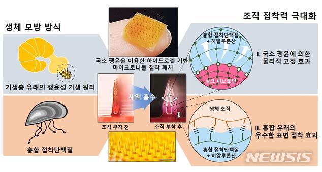 【서울=뉴시스】 해양생물 유래 접착단백질 기반의 체내외 상처 봉합용 마이크로니들 접착 패치 (제공=KIMST)