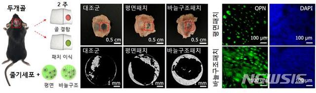 【서울=뉴시스】나노바늘구조 지압패치의 골 조직 재생. 두개골 손상 쥐 모델에 줄기세포가 결합된 나노바늘구조 지압패치를 삽입하고 2주 후에 두개골 조직 재생을 확인했다. 두개골 조직 재생이 촉진되고 골 형성 관련 단백질  마커(marker) 발현이 향상되는 것을 확인할 수 있었다. (그림/김장호 전남대 교수, 정훈의 울산과학기술원 교수 연구팀 제공)  photo@newsis.com