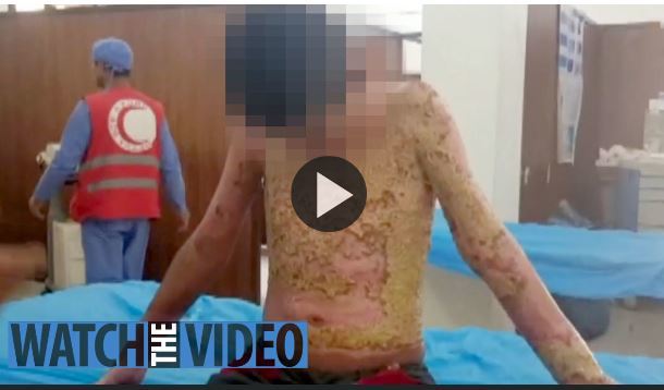 【서울=뉴시스】 터키군 또는 친터키 민병대가 쏜 백린탄에 피폭된 것으로 보이는 시리아 쿠르드 어린이가 온몸에 화상을 입고 병원에 앉아 있는 모습. 쿠르드 측은 터키 측이 민간인에 백린탄을 쐈다고 주장하고 있다. <사진출처:더선> 2019.10.18