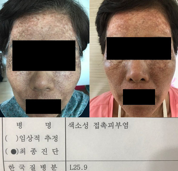 [서울=뉴시스] 헤나 염모제 관련 부작용이 속출하고 있다. 사용 후 얼굴 전체가 검게 착색됐다고 주장하는 피해자 모습(사진=인터넷 커뮤니티)