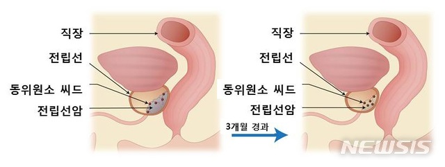  전립선 브라키테라피 용량감소 개념 모식도.