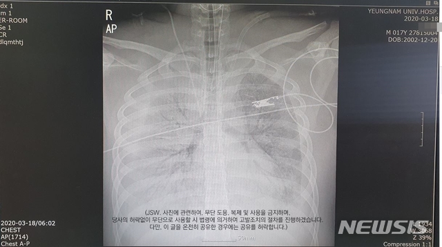 [대구=뉴시스]이은혜 기자 = 대구에서 폐렴 증세를 보이다 숨진 17세 소년의 폐 엑스레이 사진. 2020.03.26. (사진=유가족 페이스북 캡처) photo@newsis.com