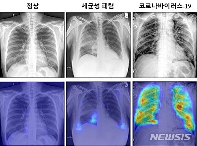 [대전=뉴시스] - KAIST서 개발한 진단 알고리즘을 통해 얻은 코로나19 확률 분포 특징 지도의 예. 다른 병변에서는 의심되는 영역이 거의 나타나지 않았으나 코로나19의 경우 고화질로 의심이 되는 부분이 표시된다.