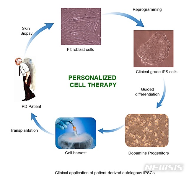 [대전=뉴시스] 맞춤형 줄기세포를 이용한 파킨슨병 치료법 모식도.