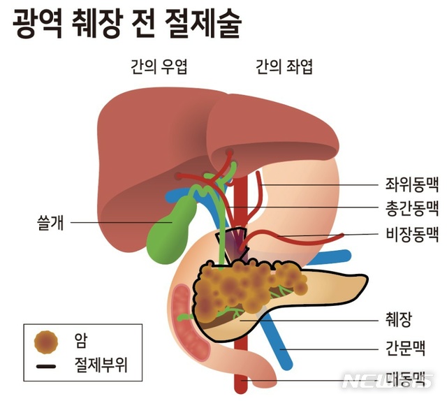 췌장암 말기, 혈관합병절제술로 암세포 완전 제거했다