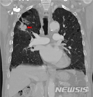 우상엽 폐암의 CT소견(화살표) (사진=뉴시스DB)
