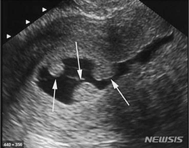 [익산=뉴시스] =자궁내막용종 초음파 사진. 