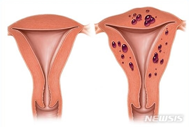 [익산=뉴시스] =정상자궁과 자궁선근증이 있는 자궁.