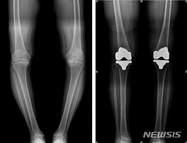[서울=뉴시스] 말기 퇴행성 무릎관절염 환자가 로봇 인공관절 수술을 받은 후 O자로 휘어진 다리(사진 왼쪽)가 일자로 바르게 교정되었다. (사진=힘찬병원 관절의학연구소 제공). 2020.10.19.