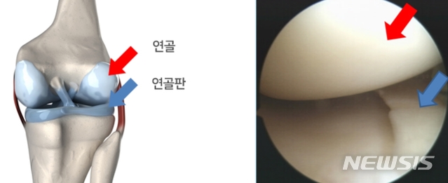 [서울=뉴시스] 무릎 연골과 연골판. (사진=부천 연세본사랑병원 제공). 2020.10.28.