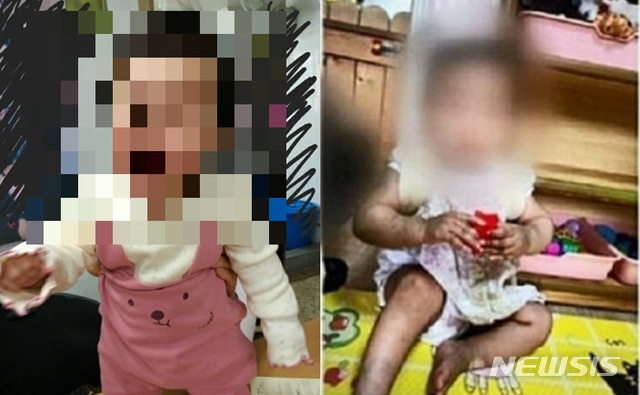 [서울=뉴시스] =서울 양천구에서 생후 16개월 여아가 사망한 사건과 관련해 아이가 입양가정에 보내지기 전(왼쪽)과 후(오른쪽)에 극명하게 달라진 모습이 담긴 사진이 공개되면서 논란이 되고 있다. 2020.11.17. 