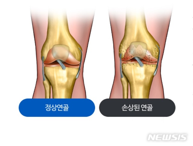 [서울=뉴시스] 정상 연골과 손상된 연골. (그림=힘찬병원 제공). 2020.12.31.