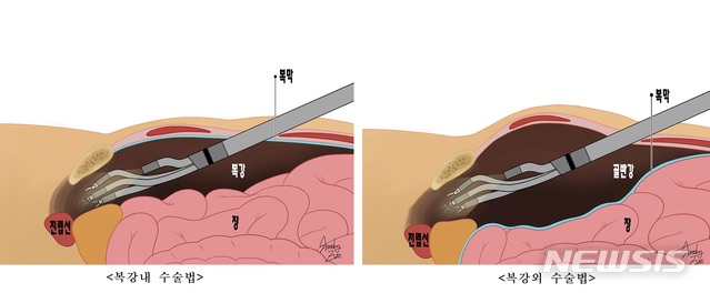 울산대병원, 복강외 로봇 전립선암 수술성공···국내최초