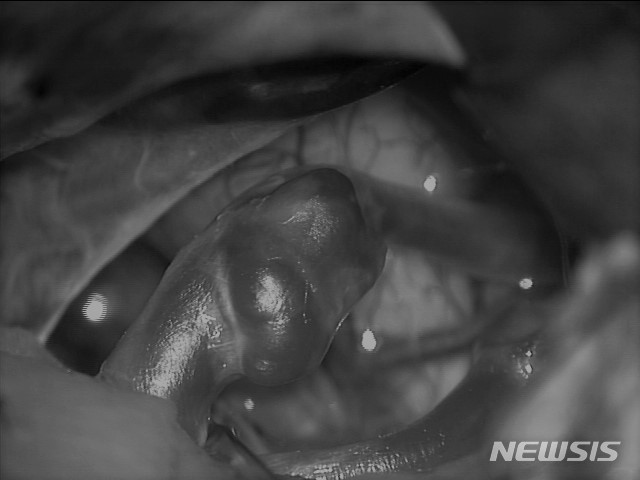 [서울=뉴시스] 뇌동맥류는 파열되면 치명적이고 치료도 복잡해 뇌동맥이 터지기 전 부풀어 있는 상태에서 발견해 치료하는 것이 중요하다. 하지만 터지기 전에는 대부분 자각 증상이 없어 두통의 원인을 찾으려고 하거나 검진 목적으로 시행한 뇌 컴퓨터단층촬영(CT)이나 자기공명영상촬영(MRI)에서 우연히 발견되는 경우가 많다. (사진= 강남세브란스 병원 제공) 2023.02.03.