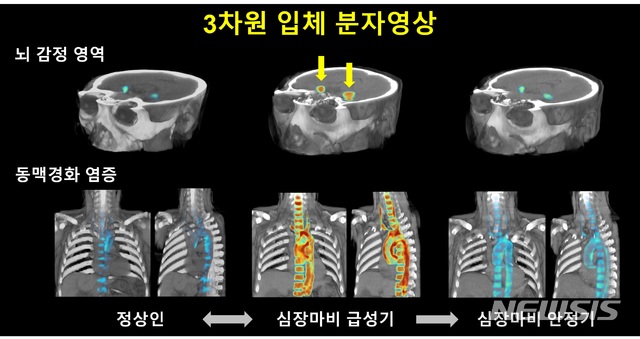 [서울=뉴시스] 대뇌 감정활성도는 심근경색의 중증도가 높을수록 뚜렷하게 증가하고, 심근경색이 회복됨에 따라 함께 감소하는 것으로 나타났다. (그림=고대구로병원 제공). 2021.01.25.