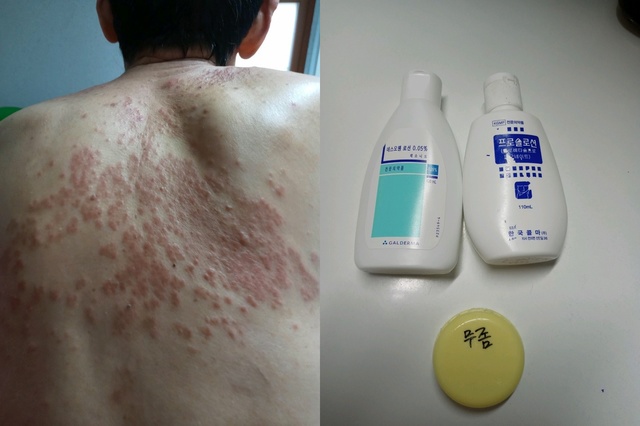 [청주=뉴시스] 조성현 기자 = 내부 종사자가 제보한 요양원 입소자의 피부 질환 상태와 치료제 사진. (사진=요양원 내부 종사자 제공) 2021.03.17. photo@newsis.com *재판매 및 DB 금지