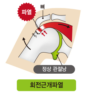 회전근개 파열은 힘줄이 손상돼 통증이 심하고 힘이 빠지는 것이 특징이다.(사진=강동경희대학교병원 제공) *재판매 및 DB 금지