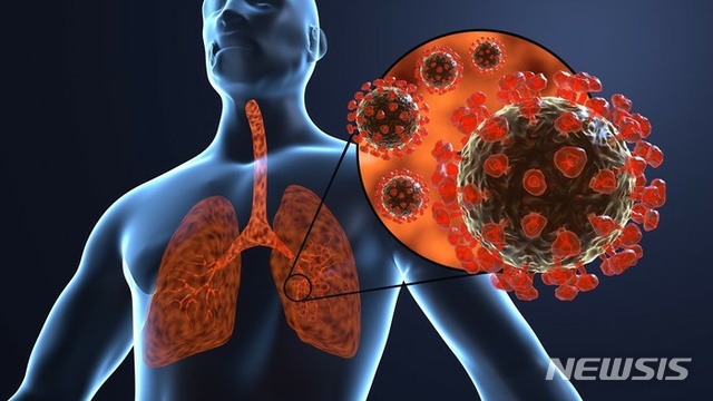 [서울=뉴시스] 간질성 폐질환은 폐포와 혈관 사이의 공간인 간질에 있는 여러 가지 세포들이 염증 반응을 일으켜 생긴다. (사진= 일산백병원 제공) 2021.03.25