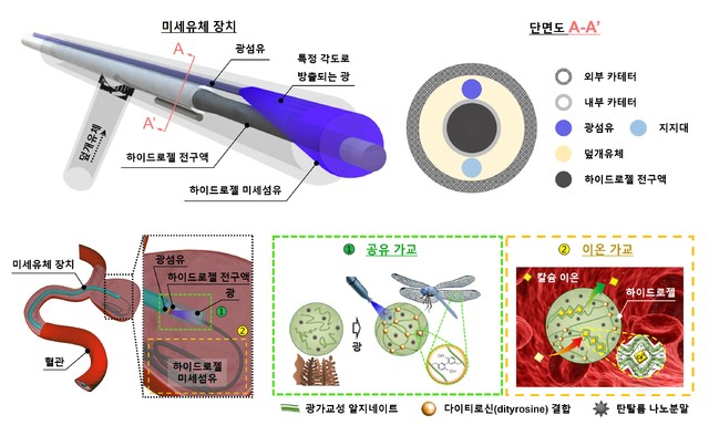 [포항=뉴시스] 강진구 기자 = 포스텍(총장 김무환)은 기계공학과 김준원 교수와 임종경 박사, 화학공학과 차형준 교수와 통합과정 최근호 씨 등 공동연구팀이 코일 색전술의 단점을 극복하기 위해 구조적으로 안정해 인체에서 분해되지 않고 장기간 유지될 수 있는 생체친화적이고 부작용이 없는 새로운 색전술용 소재를 개발했다고 12일 밝혔다.사진은 연구 관련 모식도.(사진=포스텍 제공) 2021.04.12.photo@newsis.com *재판매 및 DB 금지