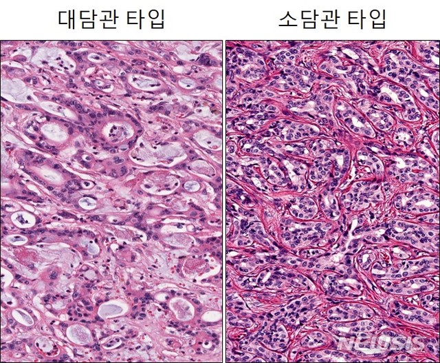[서울=뉴시스]간내담관암 환자는 BAP1, IDH1/2 유전자 돌연변이가 많은 소담관 유형과 KRAS, SMAD4 유전자 돌연변이가 많은 대담관 유형으로 나눠졌고 대담관 유형이 소담관 유형보다 항암제 반응이 더 좋지 않은 것으로 나타났다. (자료= 세브란스병원 제공) 2021.04.27