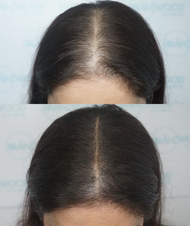 두피 문신 *재판매 및 DB 금지